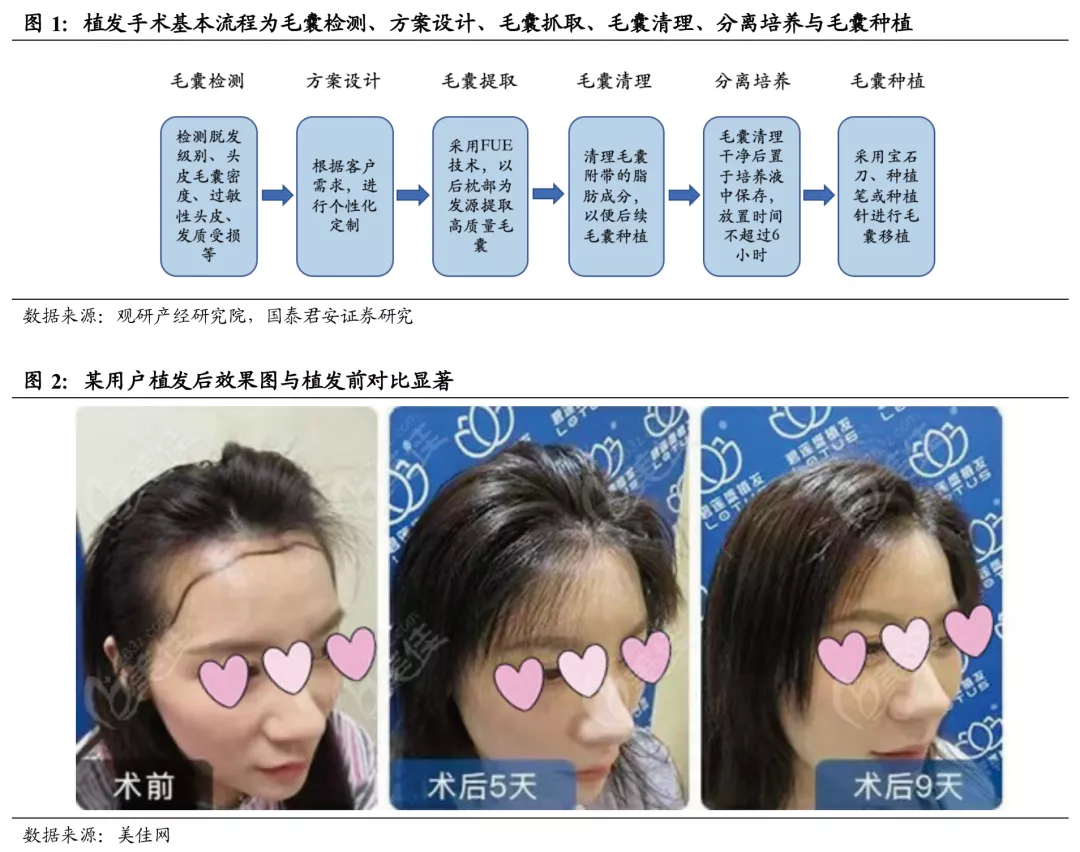 韩国植发 | 女性植发达到自然效果重点在于“碎发效果” - 哔哩哔哩